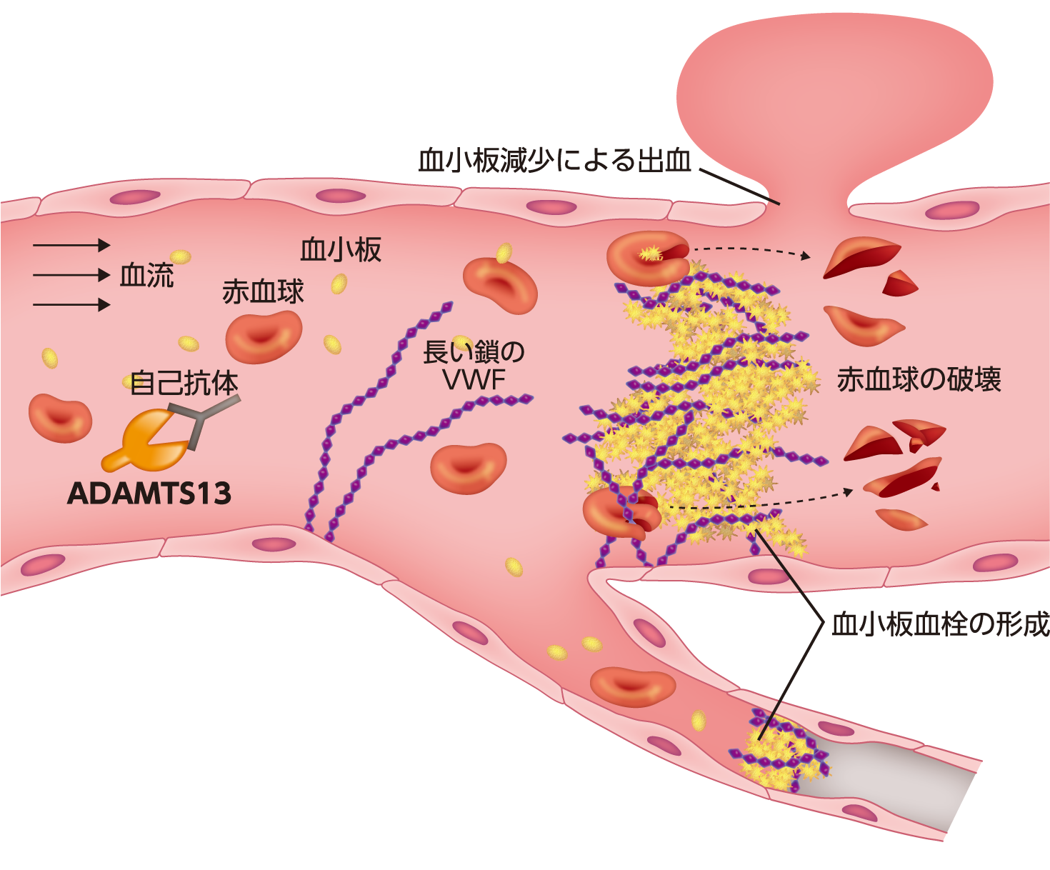 後天性TTP患者さんの血管内（自己抗体によってADAMTS13活性が低下）イメージイラスト